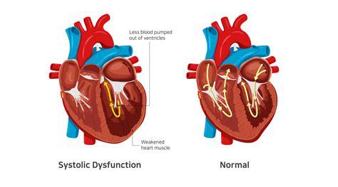 mild lv systolic dysfunction means|cause of systolic heart failure.